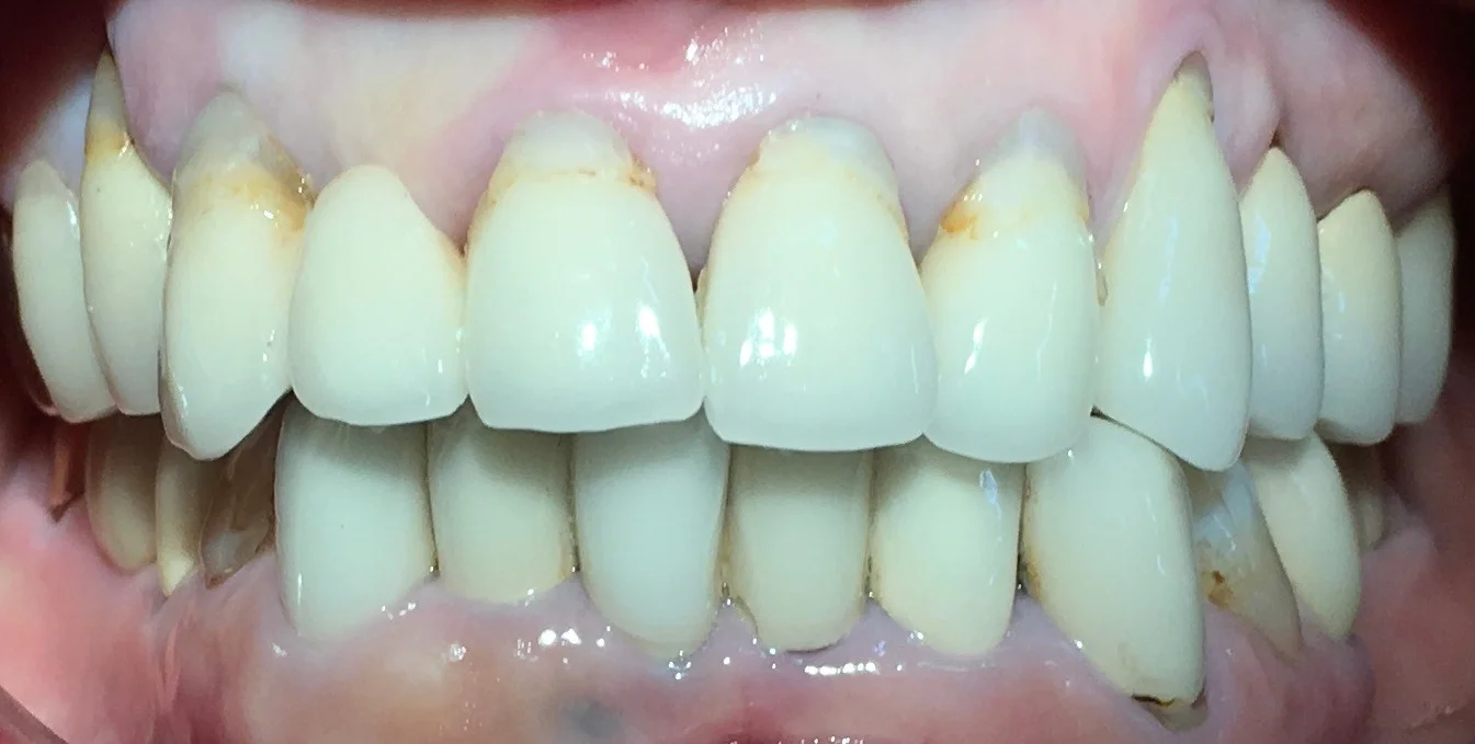 オールセラミックスブリッジ|坂寄歯科医院(取手市藤代)