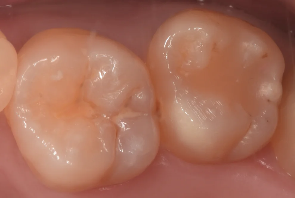 新しくできた虫歯と古い詰め物を同時に治療。｜坂寄歯科医院（取手市藤代）