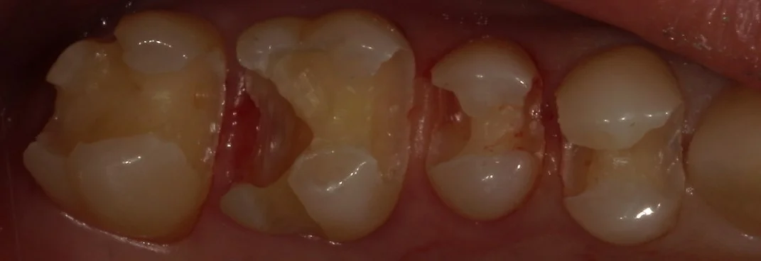 全体的に金属を白い詰め物に。|坂寄歯科医院(取手市藤代) - 画像3
