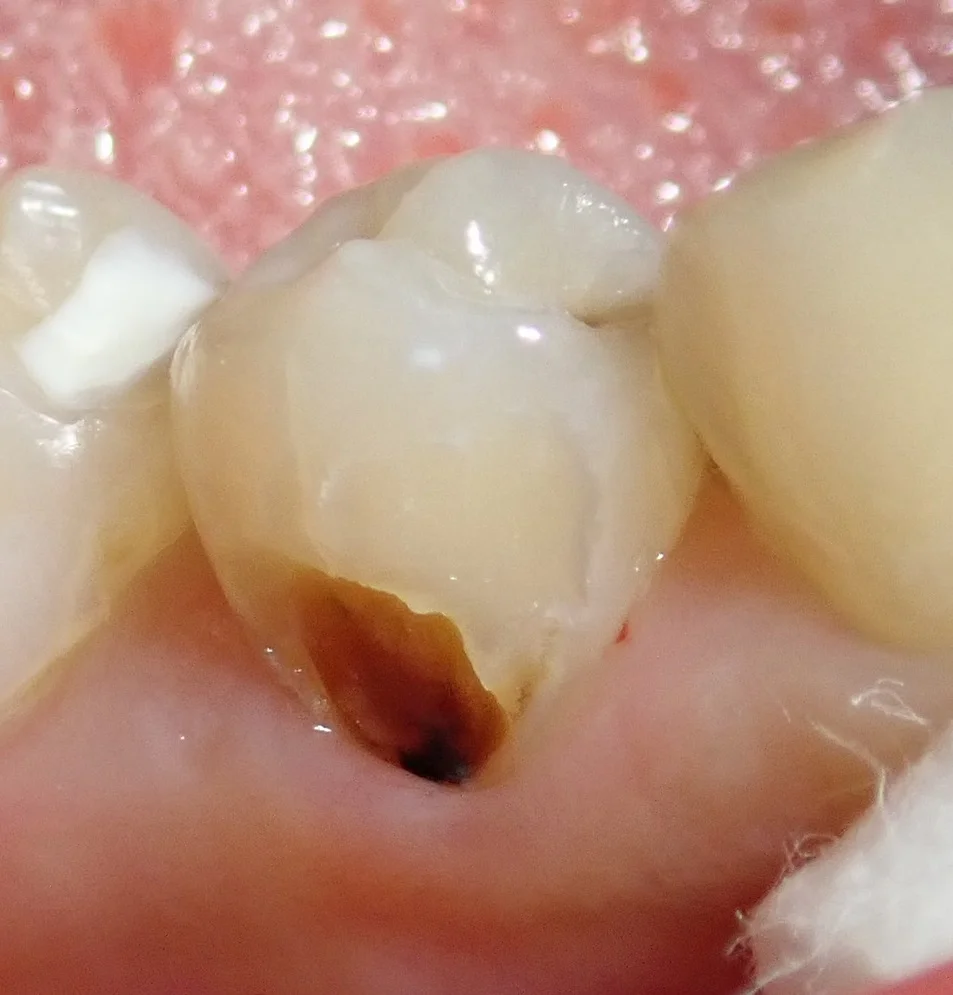 圧排糸を使ったレジン治療。｜坂寄歯科医院（取手市藤代） - 画像2