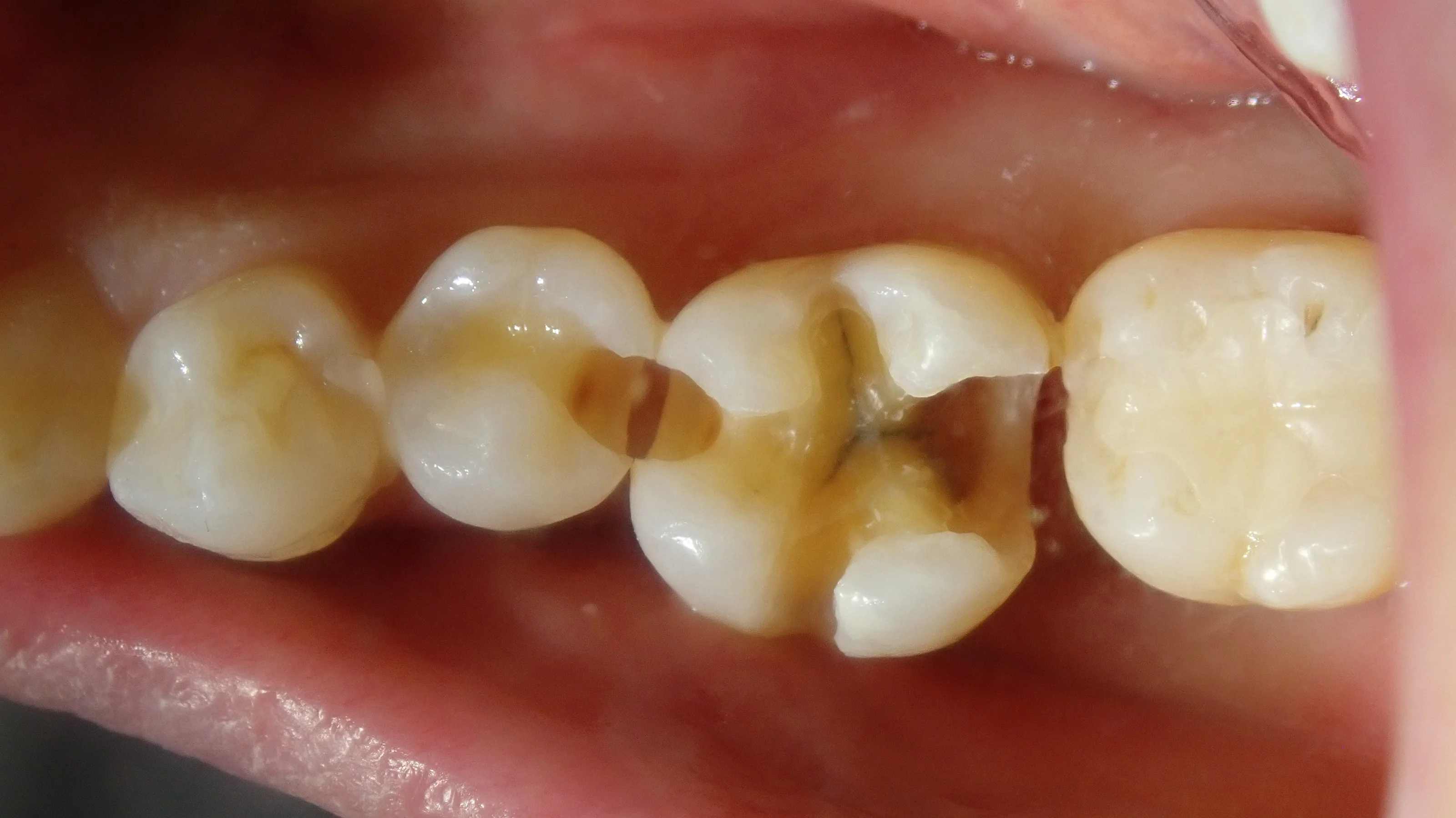 ダイレクトボンディング⑦|坂寄歯科医院(取手市藤代) - 画像4