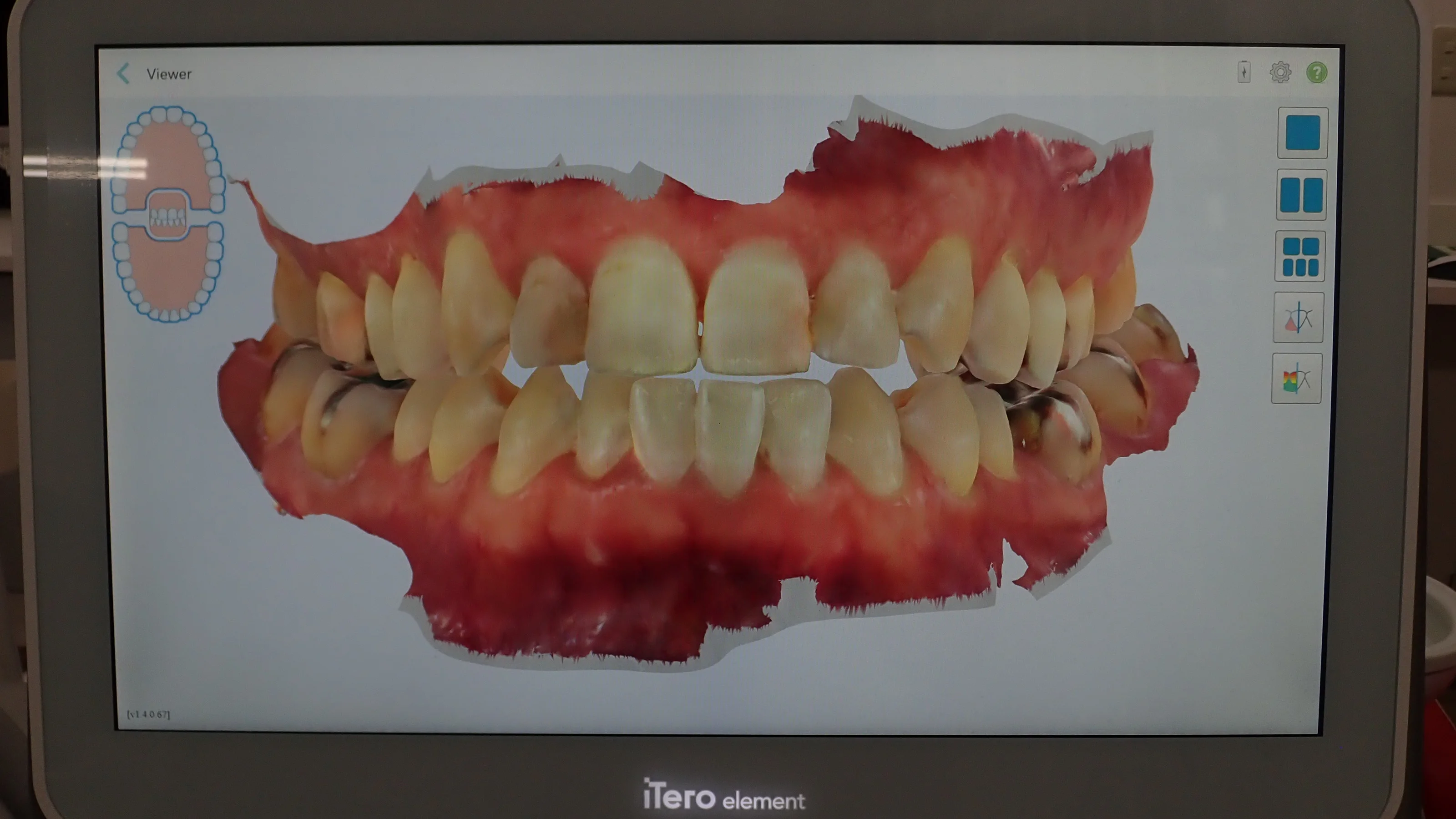 口腔内スキャナを導入しました。|坂寄歯科医院(取手市藤代)