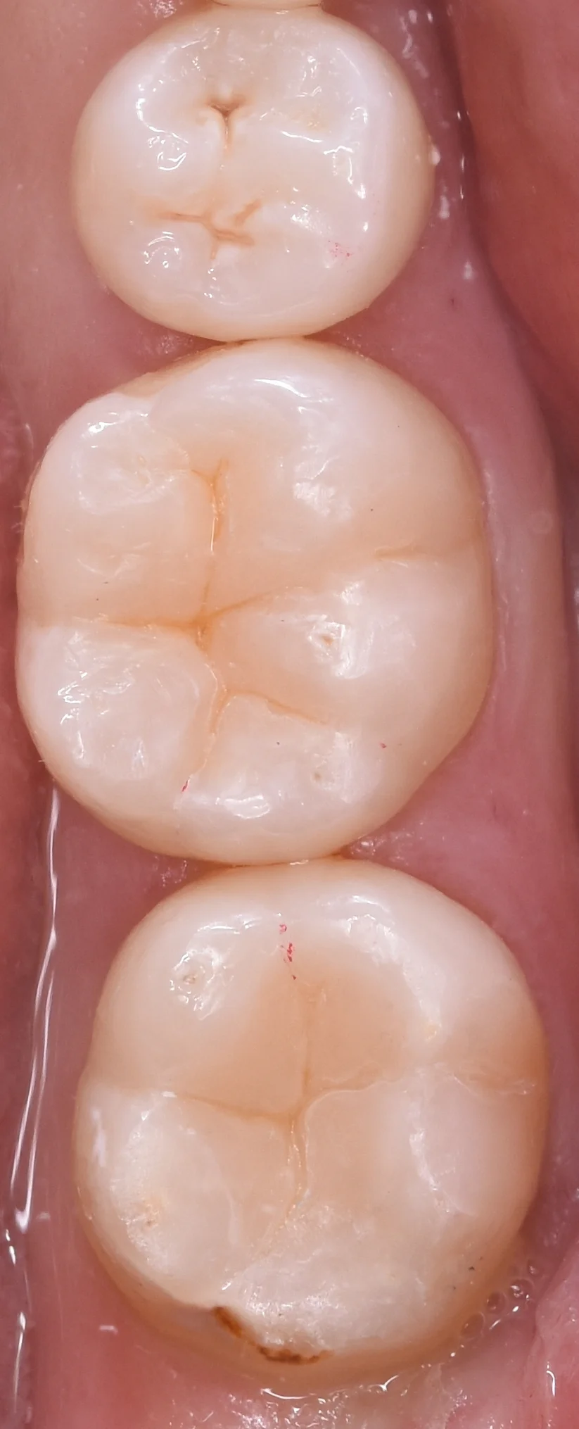 他県にて勤務中の歯科衛生士の方の治療。｜坂寄歯科医院（取手市藤代） - 画像4