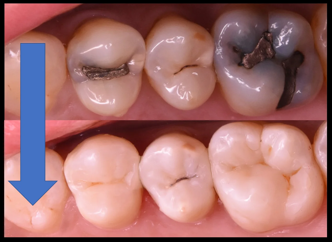 奥歯3本を纏めて一気に治療。|坂寄歯科医院(取手市藤代) - 画像5