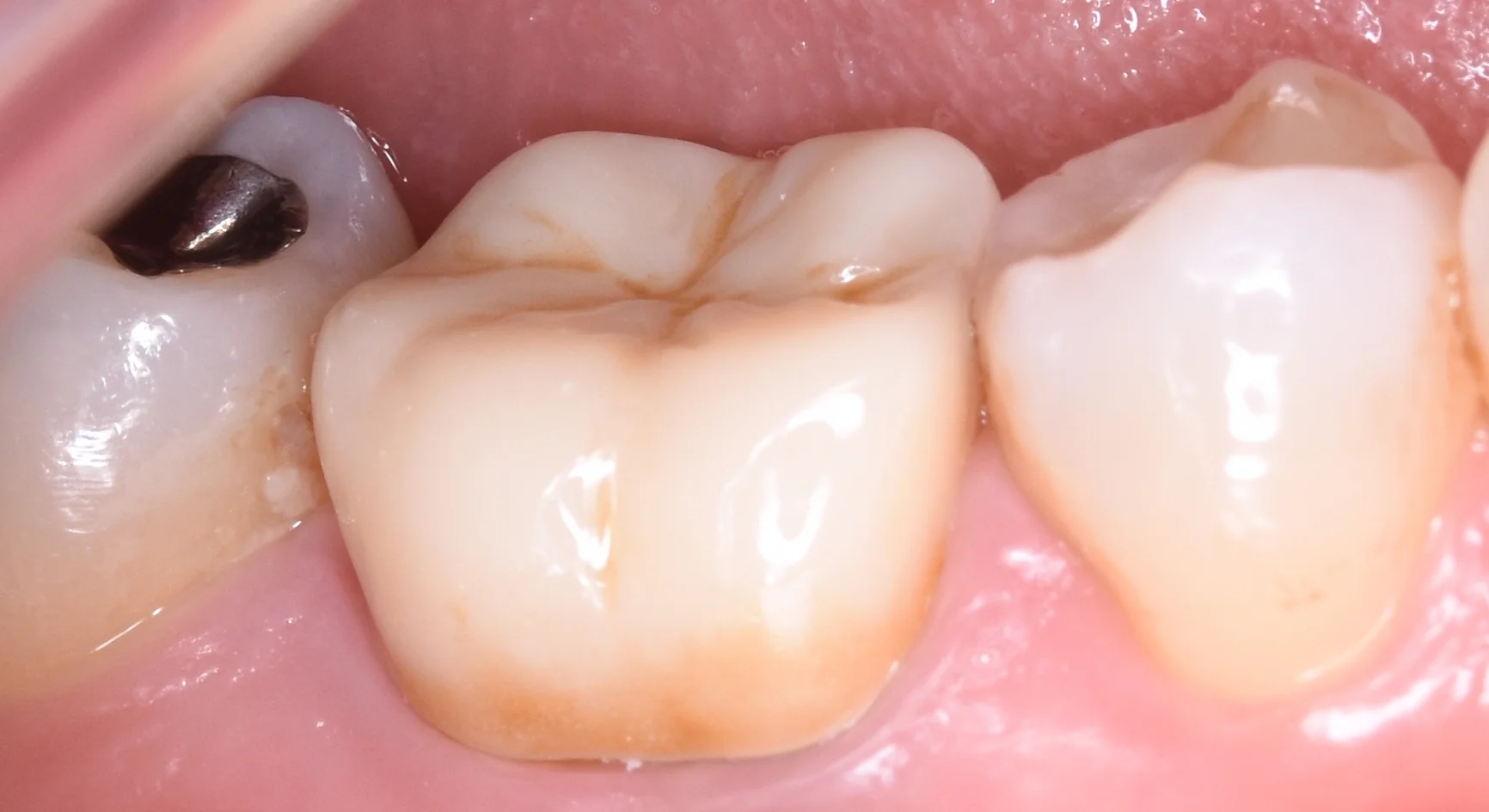 セラミックの被せ物|坂寄歯科医院(取手市藤代) - 画像3