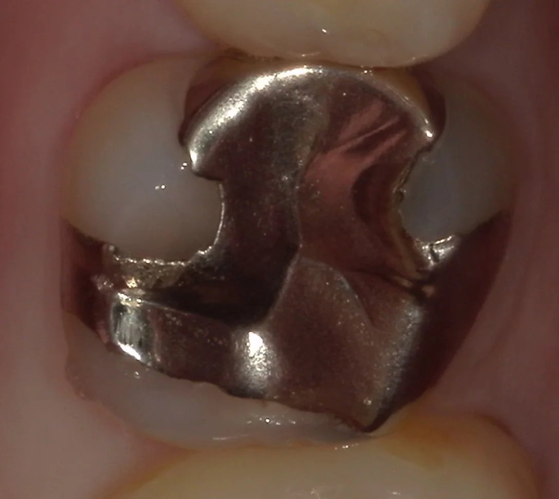 歯の側面も同時に治療したケース。|坂寄歯科医院(取手市藤代)