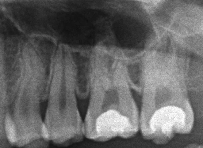 ダイレクトボンディング(処置後3年経過)|坂寄歯科医院(取手市藤代) - 画像3