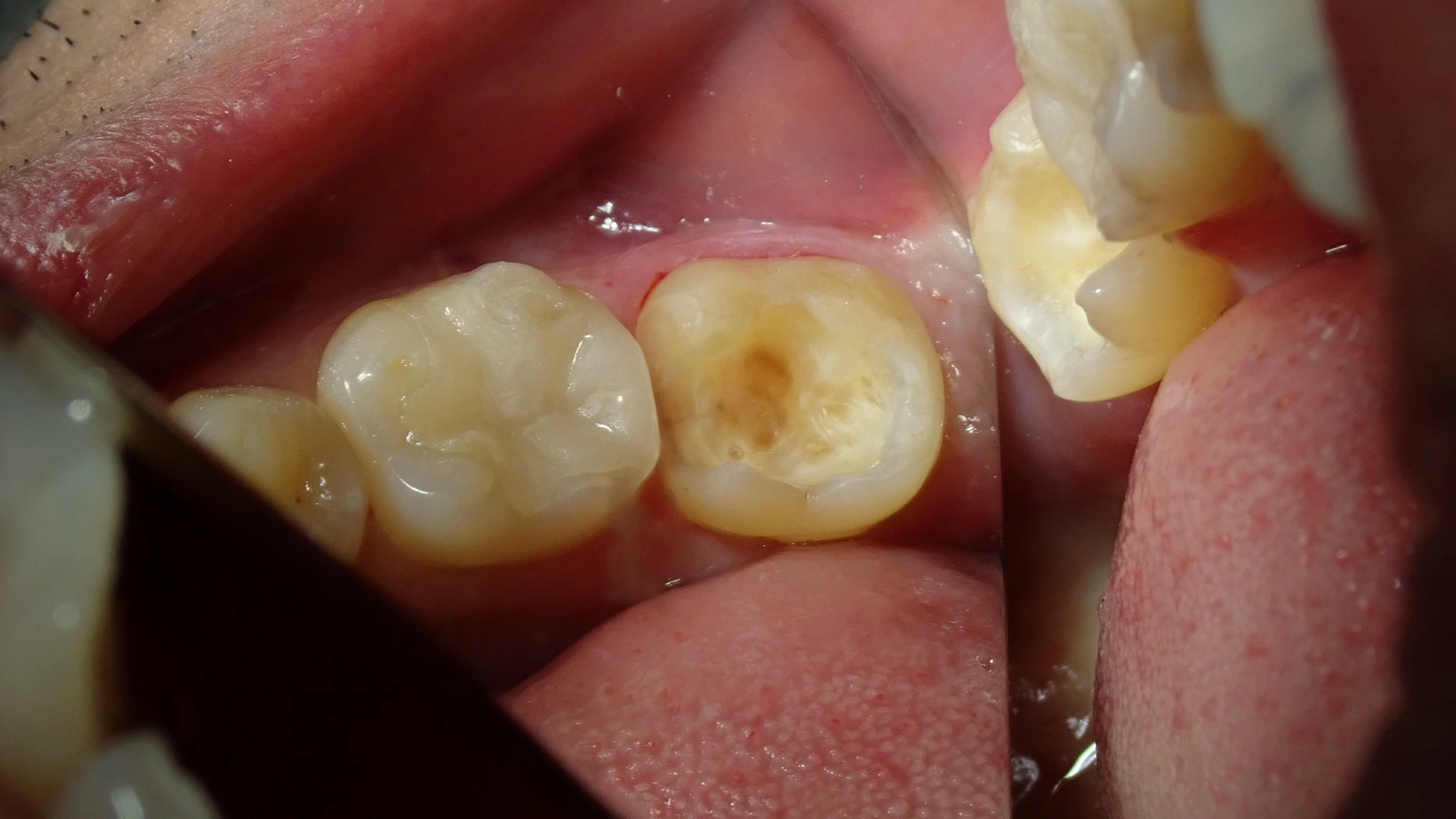左下奥の白い詰め物｜坂寄歯科医院（取手市藤代） - 画像2