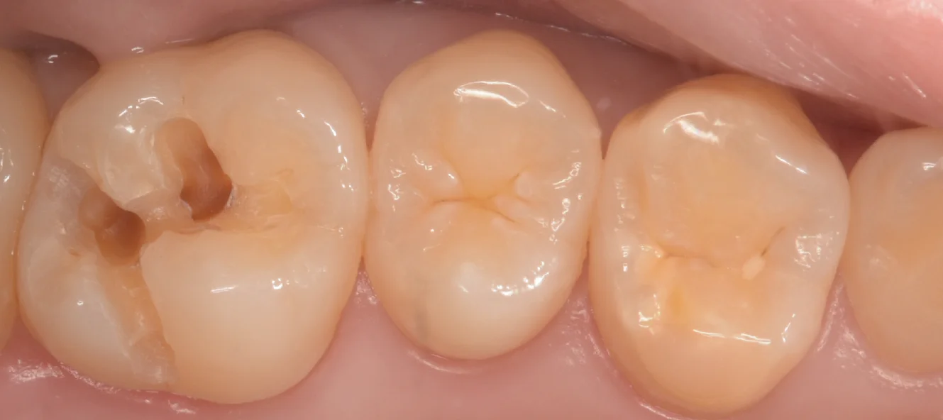 自費の白い詰め物。|坂寄歯科医院(取手市藤代) - 画像2