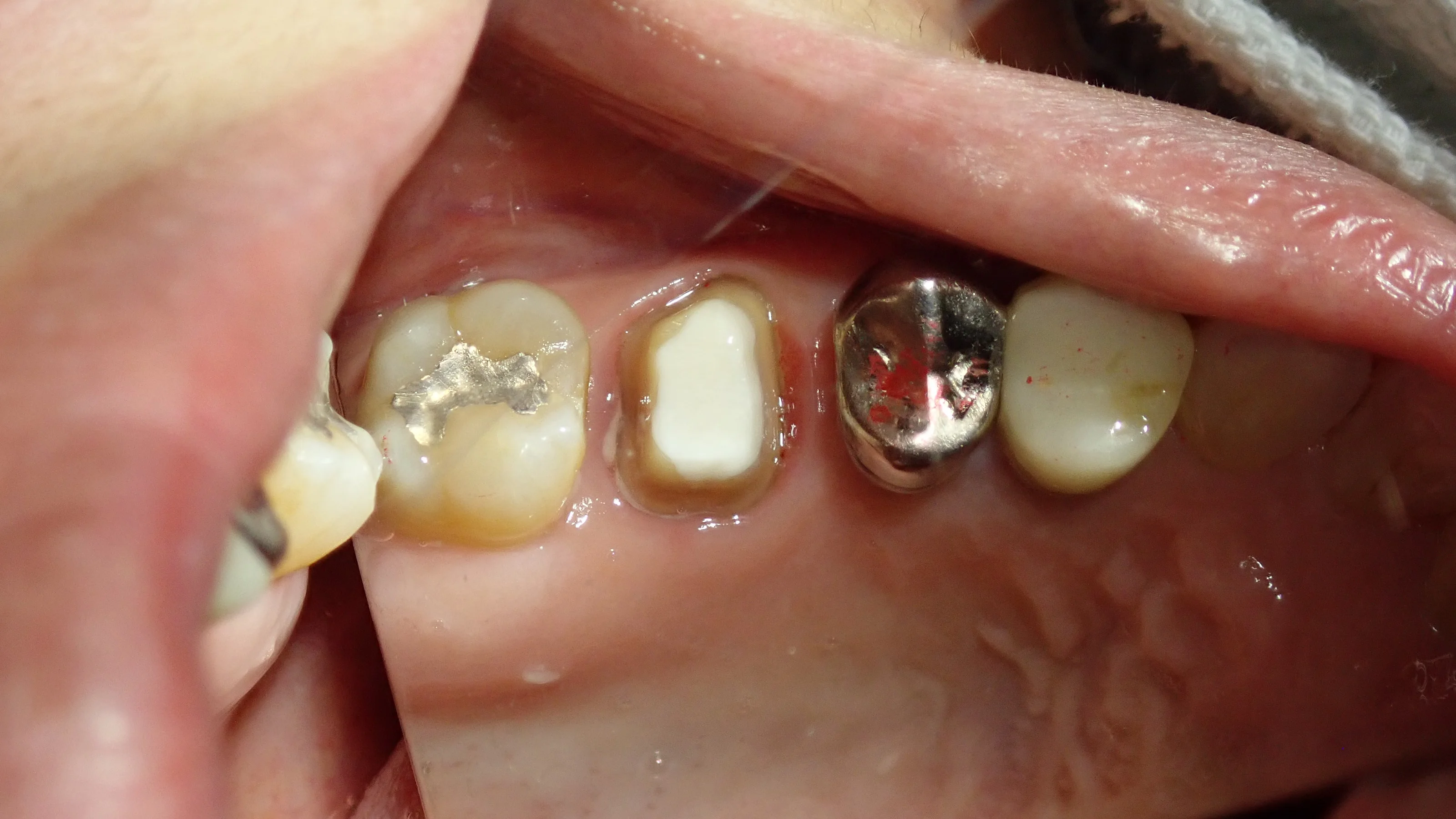 被せ物が無調整で入るとすっごく気持ちいい。|坂寄歯科医院(取手市藤代) - 画像3