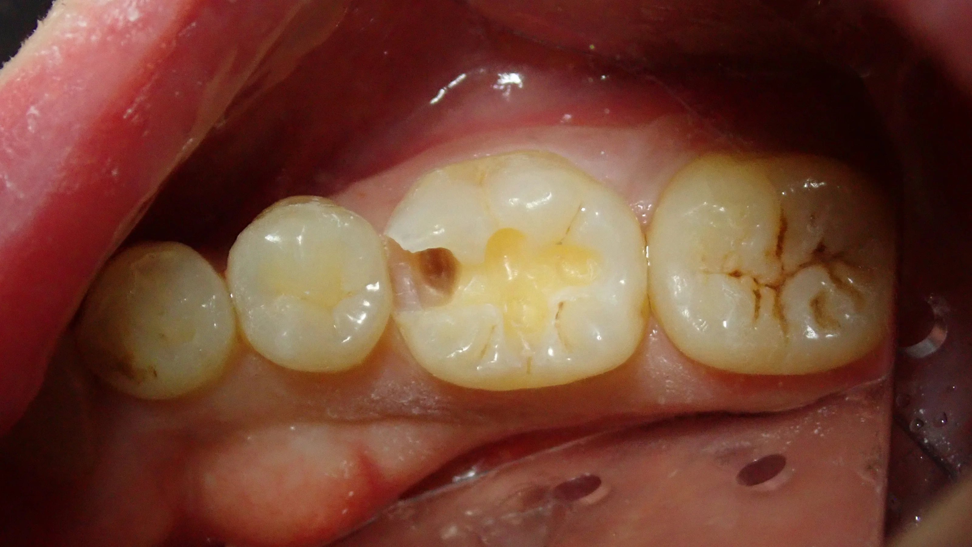 ダイレクトボンディング⑧|坂寄歯科医院(取手市藤代) - 画像4