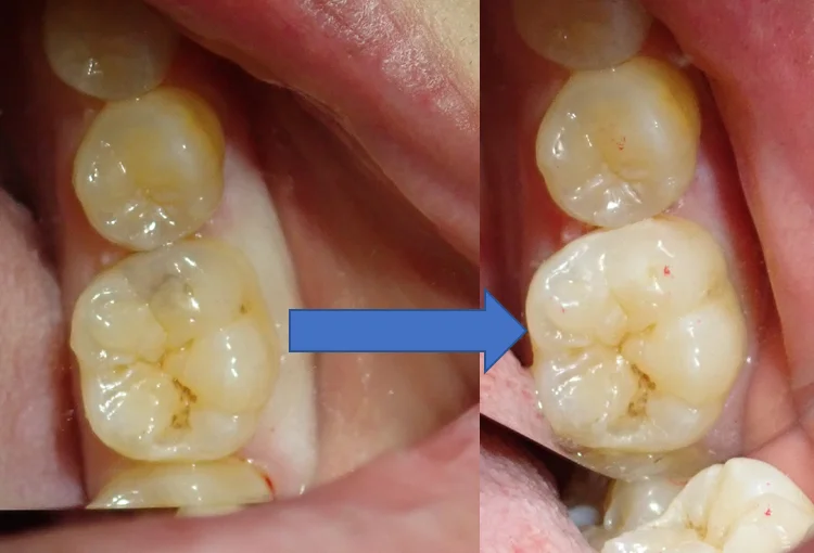 虫歯はない・・・?本当に・・・?|坂寄歯科医院(取手市藤代) - 画像5