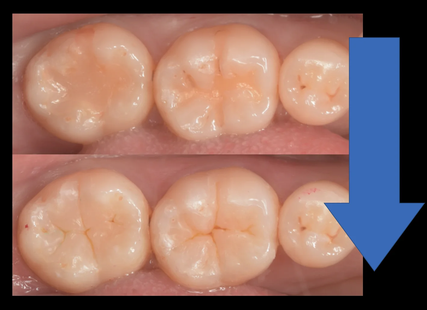 見た目が気になるレジンを天然の歯の様に。|坂寄歯科医院(取手市藤代) - 画像4