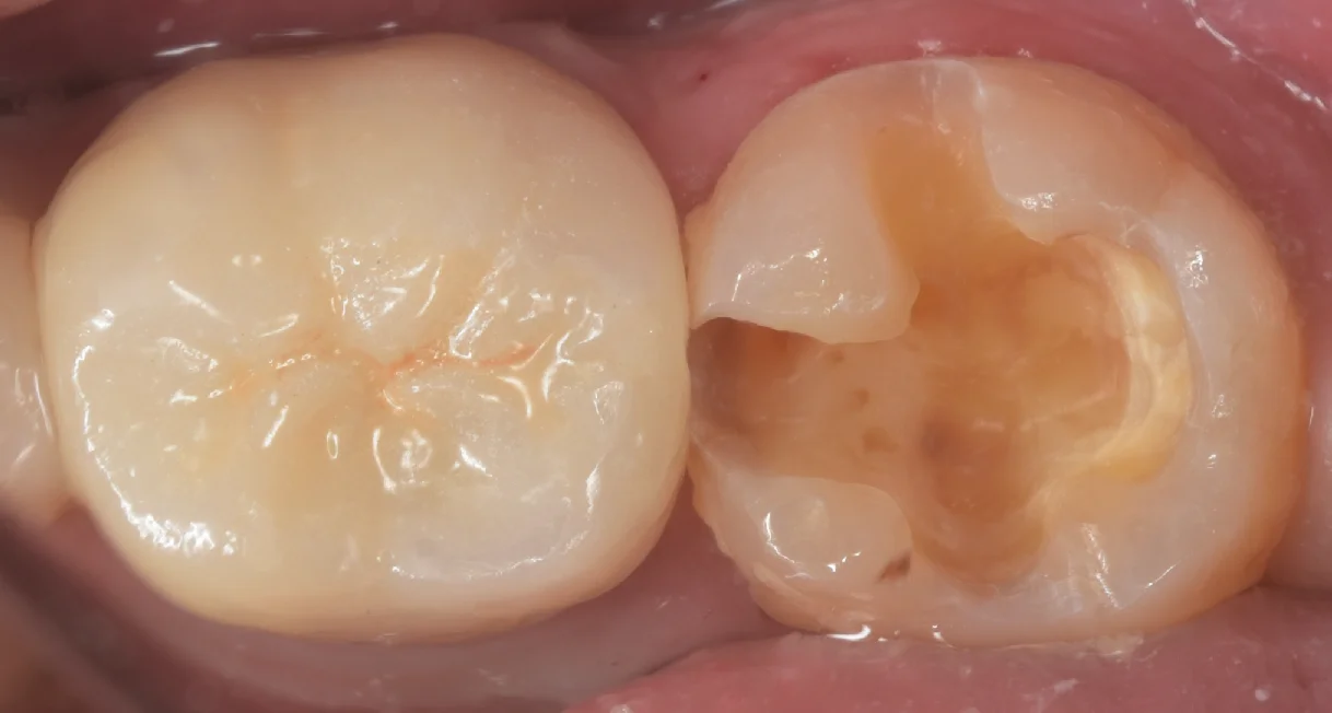 古い白い詰め物を詰め直し｜坂寄歯科医院（取手市藤代） - 画像3