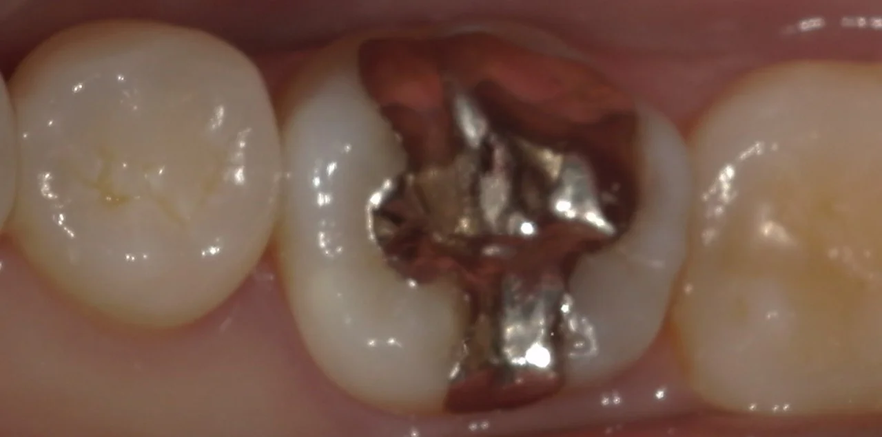 他院勤務中の歯科衛生士さんの治療を行いました。|坂寄歯科医院(取手市藤代)