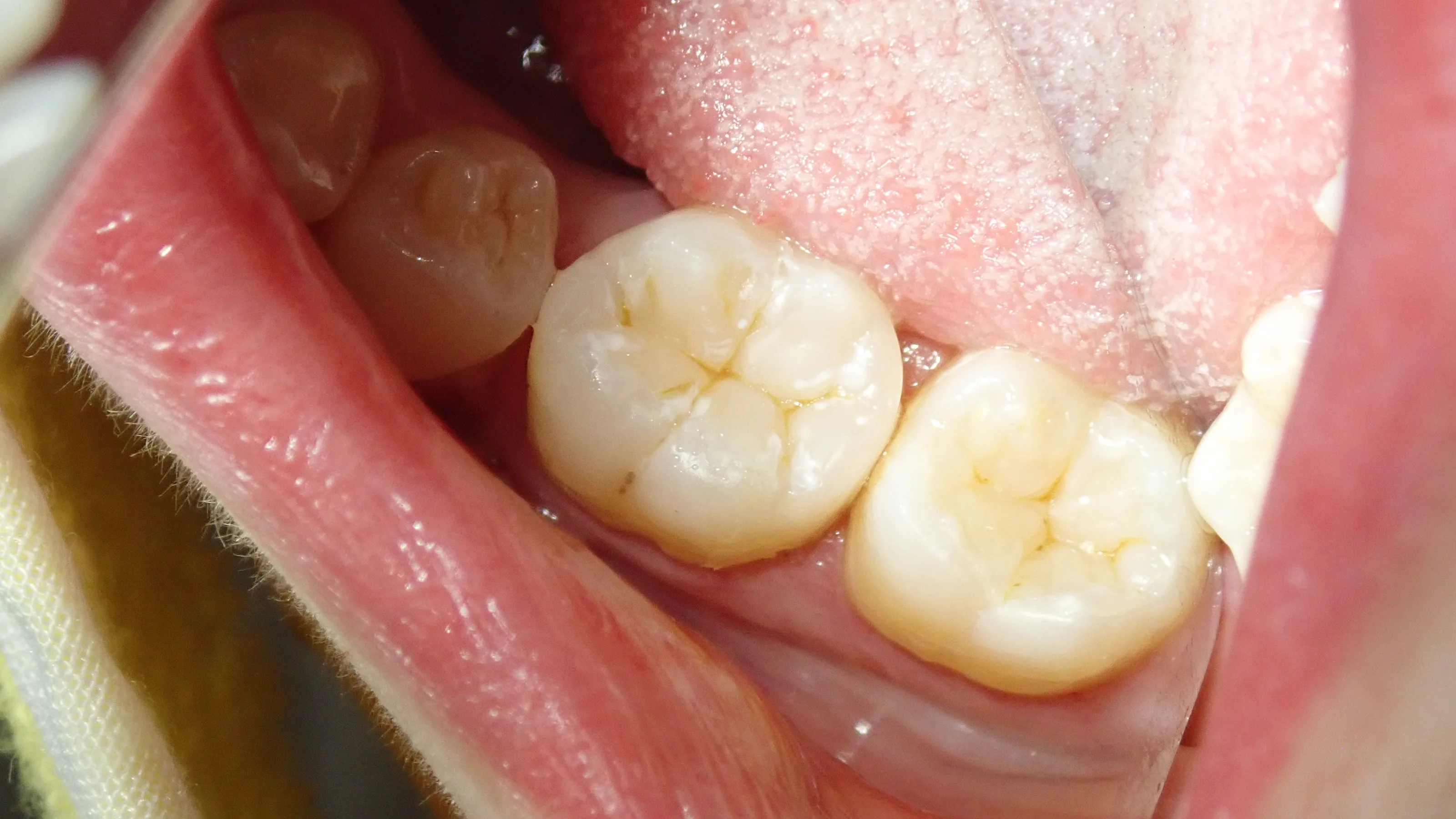 奥2本のダイレクトボンディング|坂寄歯科医院(取手市藤代) - 画像7