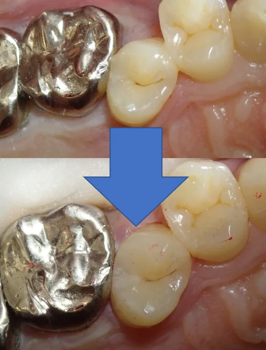 左上3本まとめてダイレクトボンディング｜坂寄歯科医院（取手市藤代） - 画像7