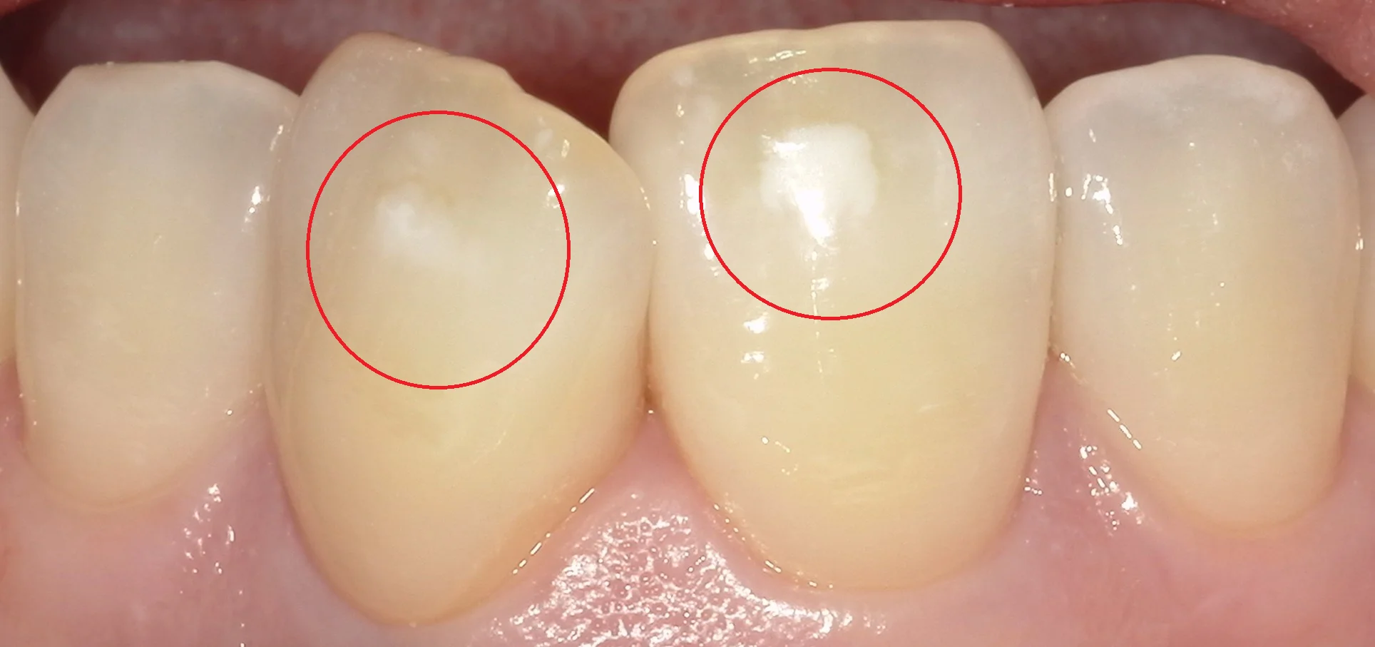 ICON治療(低侵襲ホワイトスポット改善治療)を始めました。｜坂寄歯科医院（取手市藤代）