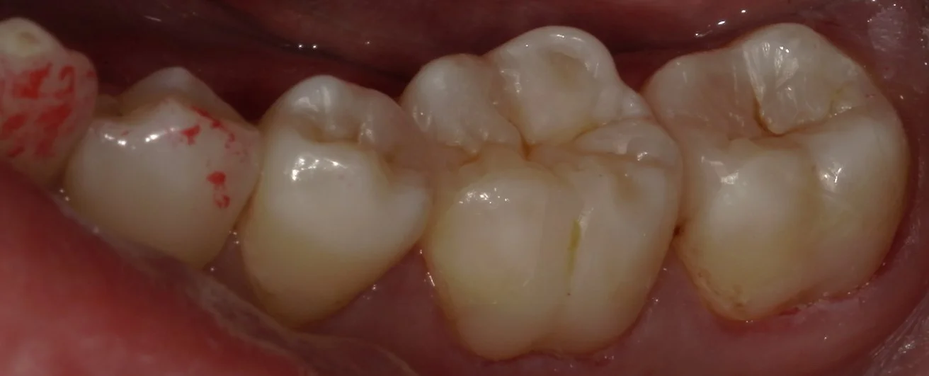 遠方から纏めて治療を希望の方。｜坂寄歯科医院（取手市藤代） - 画像4