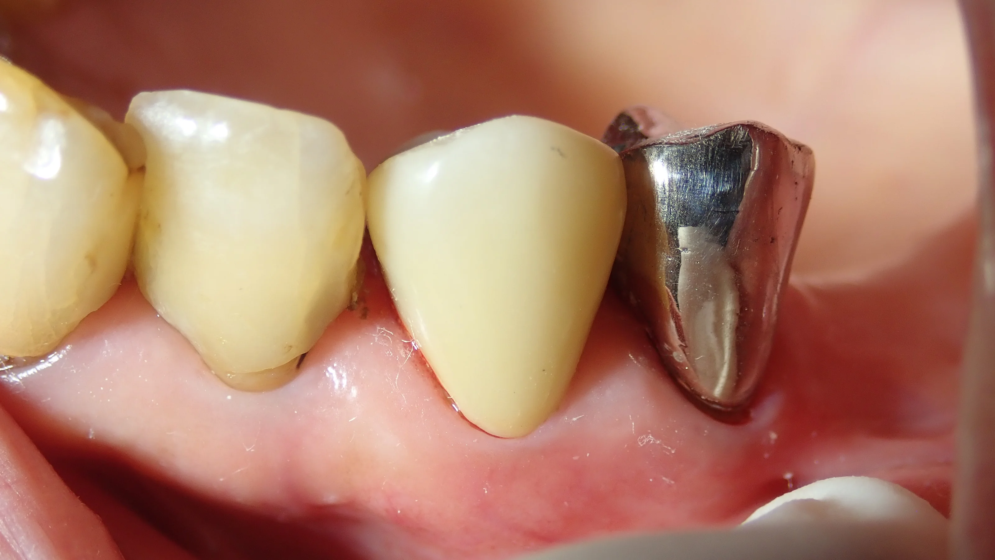 硬質レジンジャケット冠|坂寄歯科医院(取手市藤代) - 画像6