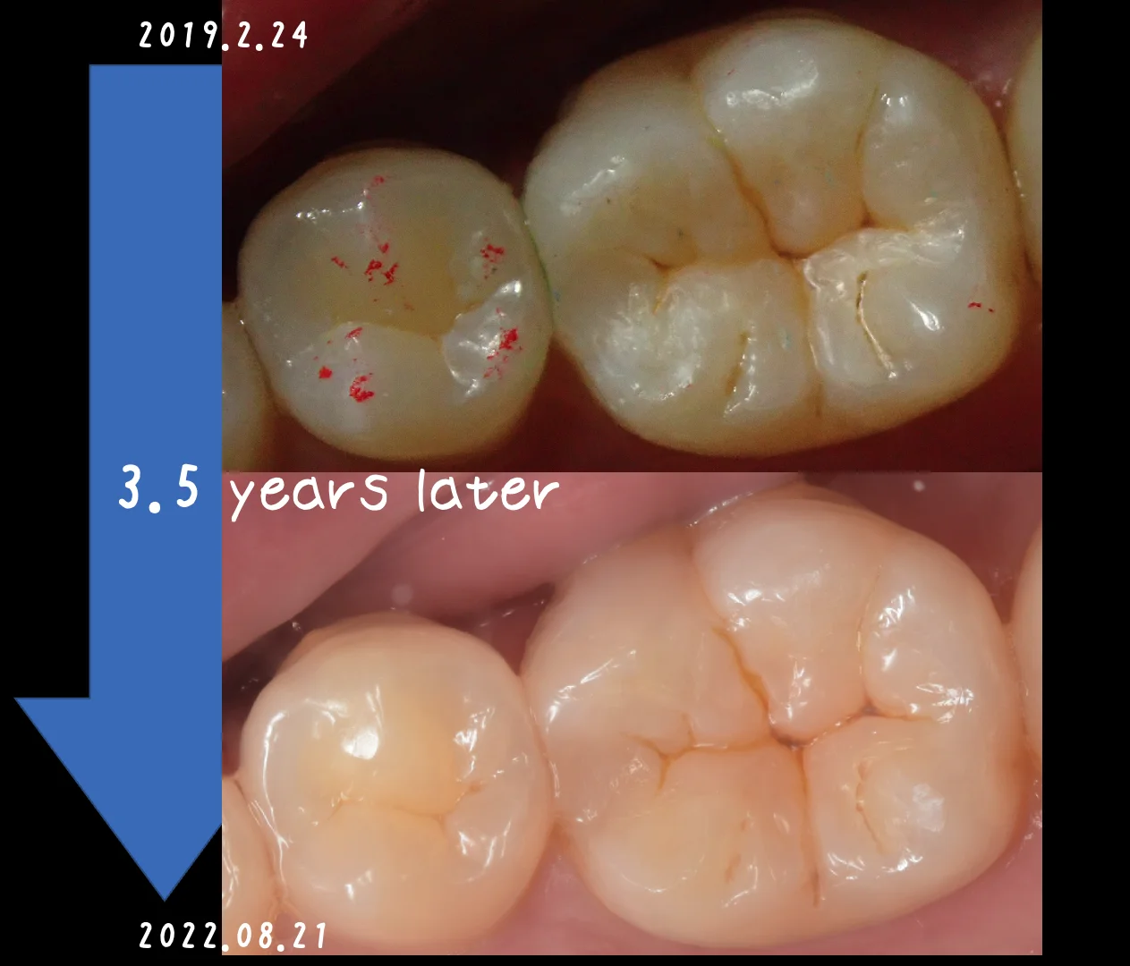 ダイレクトボンディングの長期経過｜坂寄歯科医院（取手市藤代） - 画像7