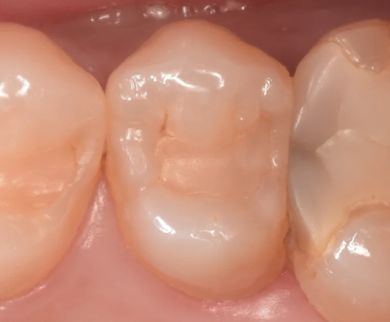 開業歯科医師の方を治療。｜坂寄歯科医院（取手市藤代）