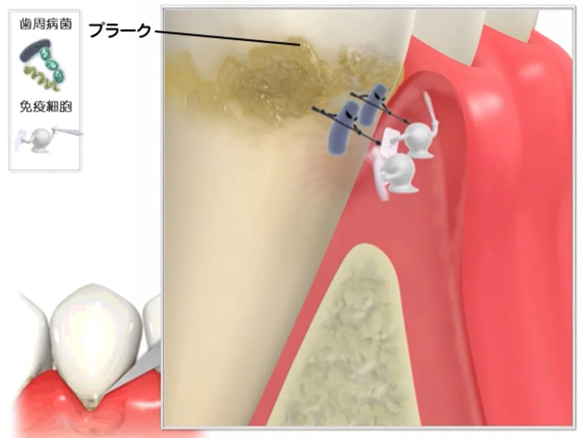 Q&A~歯周病ってなに?①~|坂寄歯科医院(取手市藤代) - 画像3
