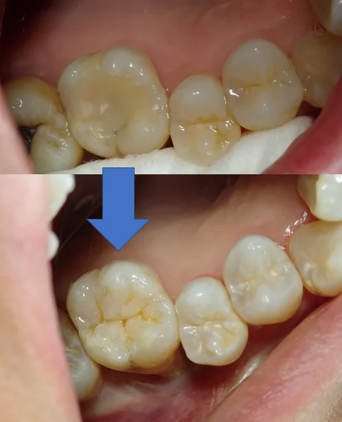 右上6ダイレクトボンディング|坂寄歯科医院(取手市藤代) - 画像7