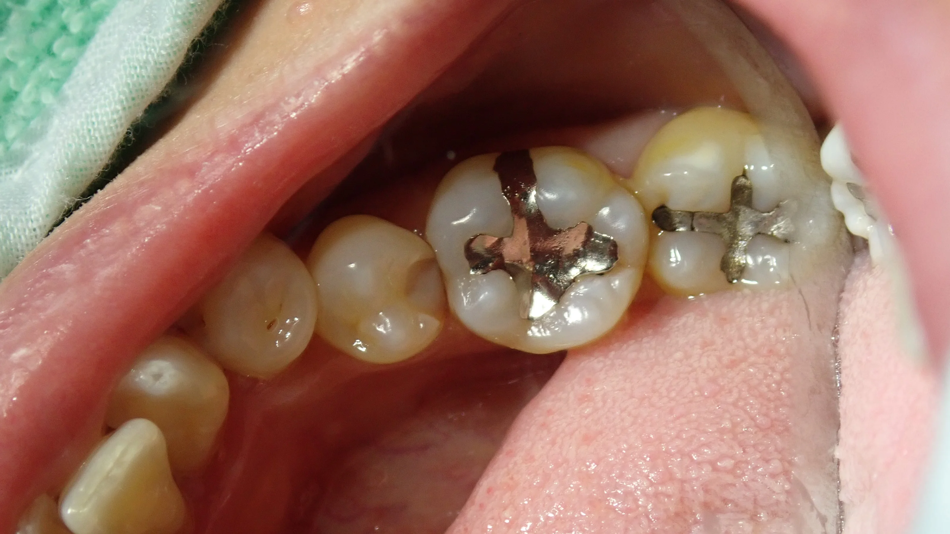 下の奥歯2本の詰め物|坂寄歯科医院(取手市藤代)