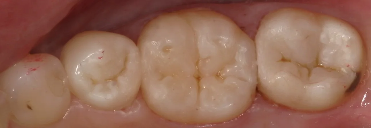 1回で纏めて一気に白い歯へ。|坂寄歯科医院(取手市藤代) - 画像4