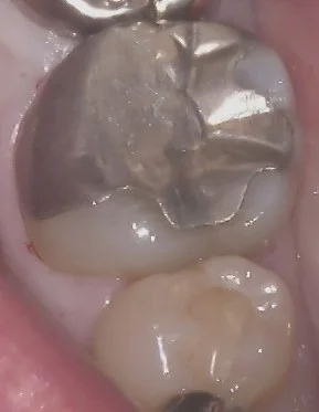 左下奥歯の白い詰め物｜坂寄歯科医院（取手市藤代）