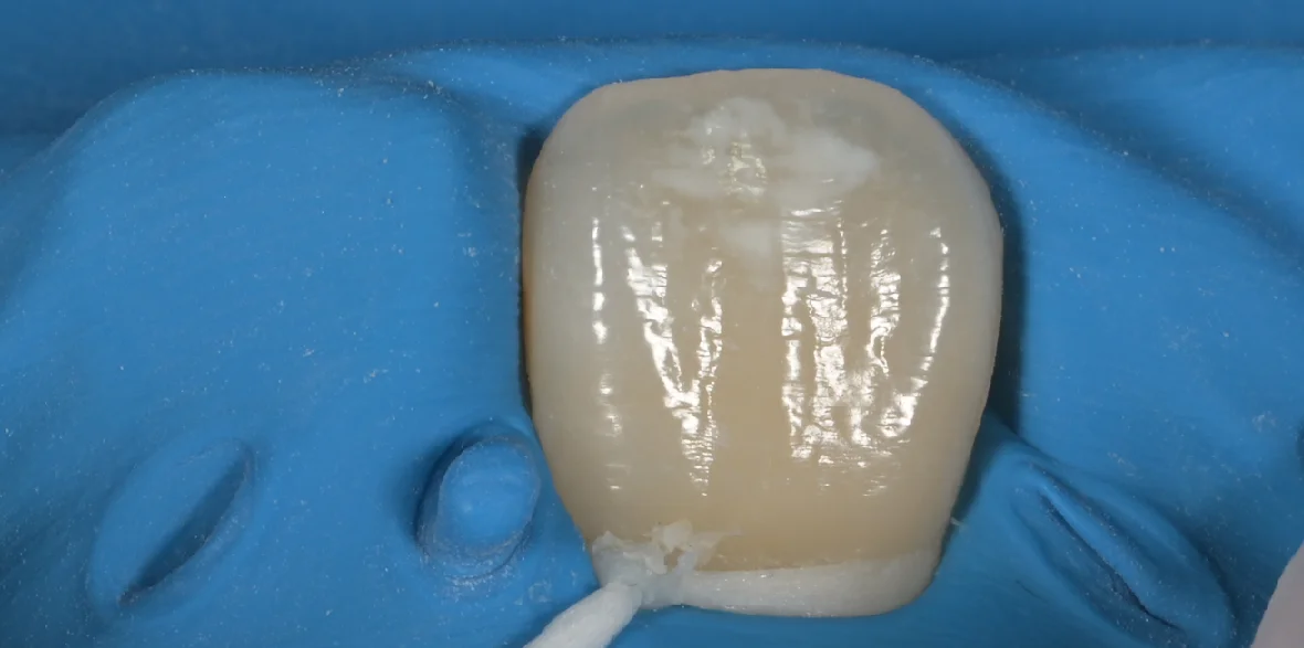 ICON治療にてホワイトスポットを改善。|坂寄歯科医院(取手市藤代) - 画像3