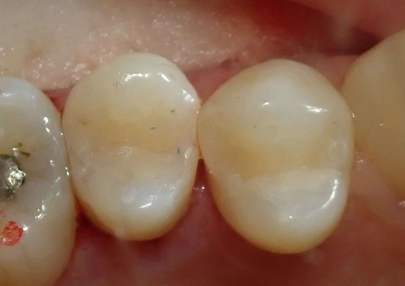 保険の白い詰め物|坂寄歯科医院(取手市藤代) - 画像5