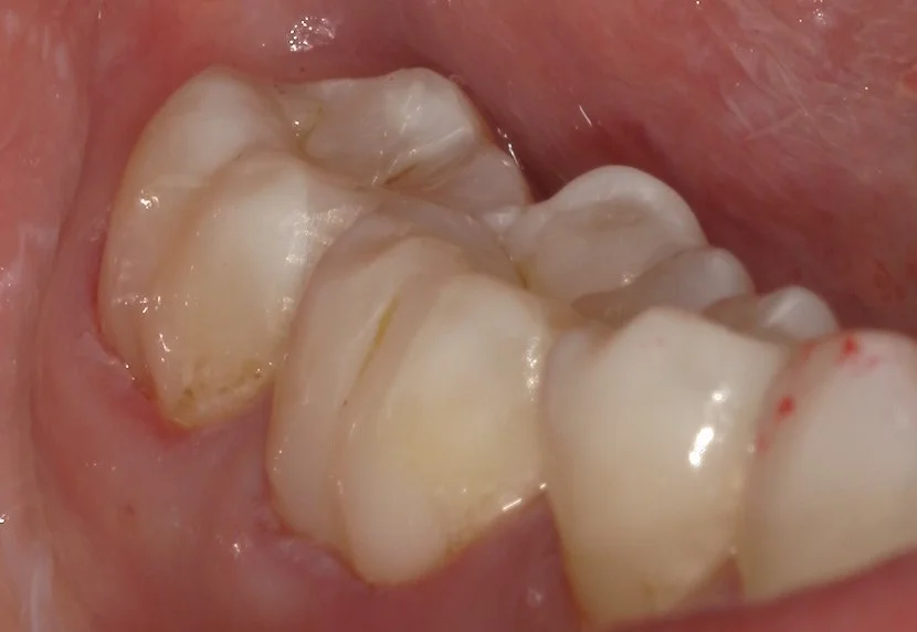 遠方から纏めて治療を希望の方。｜坂寄歯科医院（取手市藤代） - 画像5