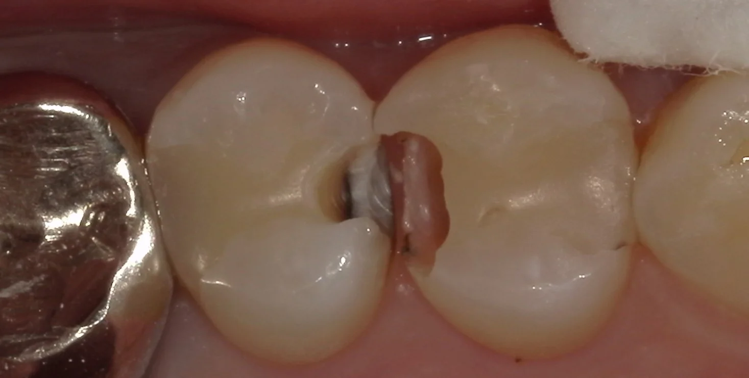 保険内の白い詰め物(コンポジットレジン修復)｜坂寄歯科医院（取手市藤代） - 画像2