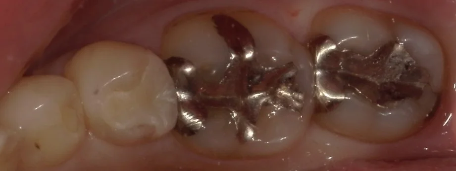 1回で纏めて一気に白い歯へ。|坂寄歯科医院(取手市藤代)