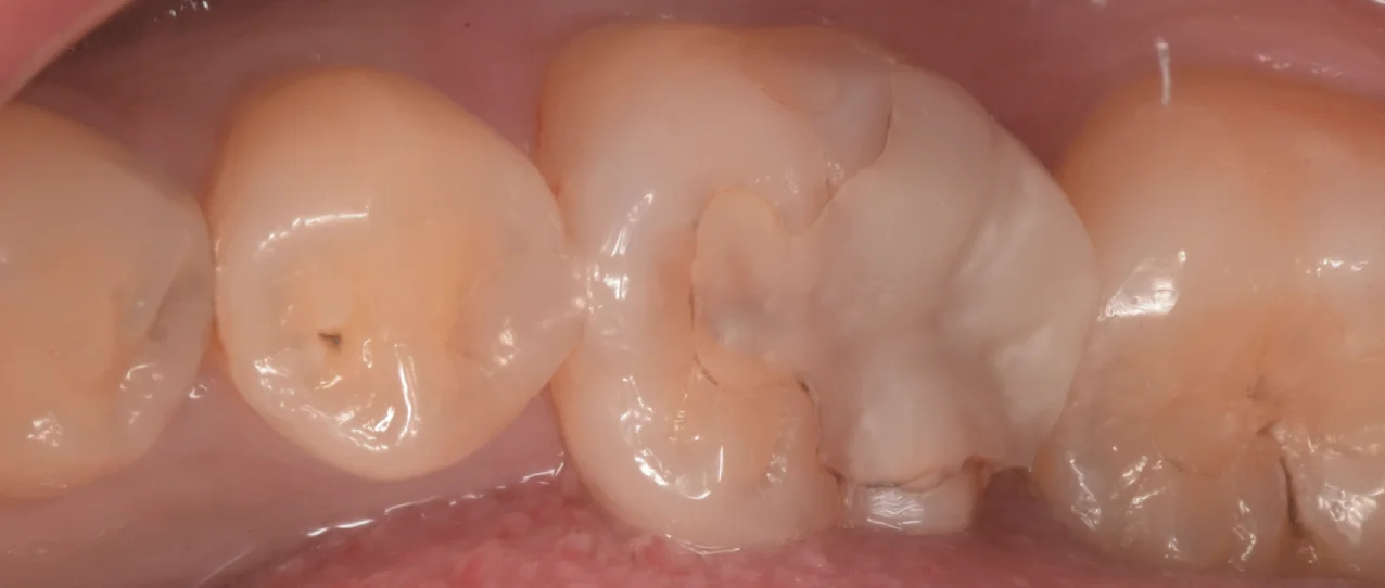 歯科医師の方のCAD/CAMインレーを治療。｜坂寄歯科医院（取手市藤代）