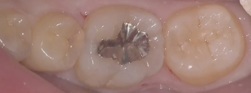 複数本を一気に治療。｜坂寄歯科医院（取手市藤代）