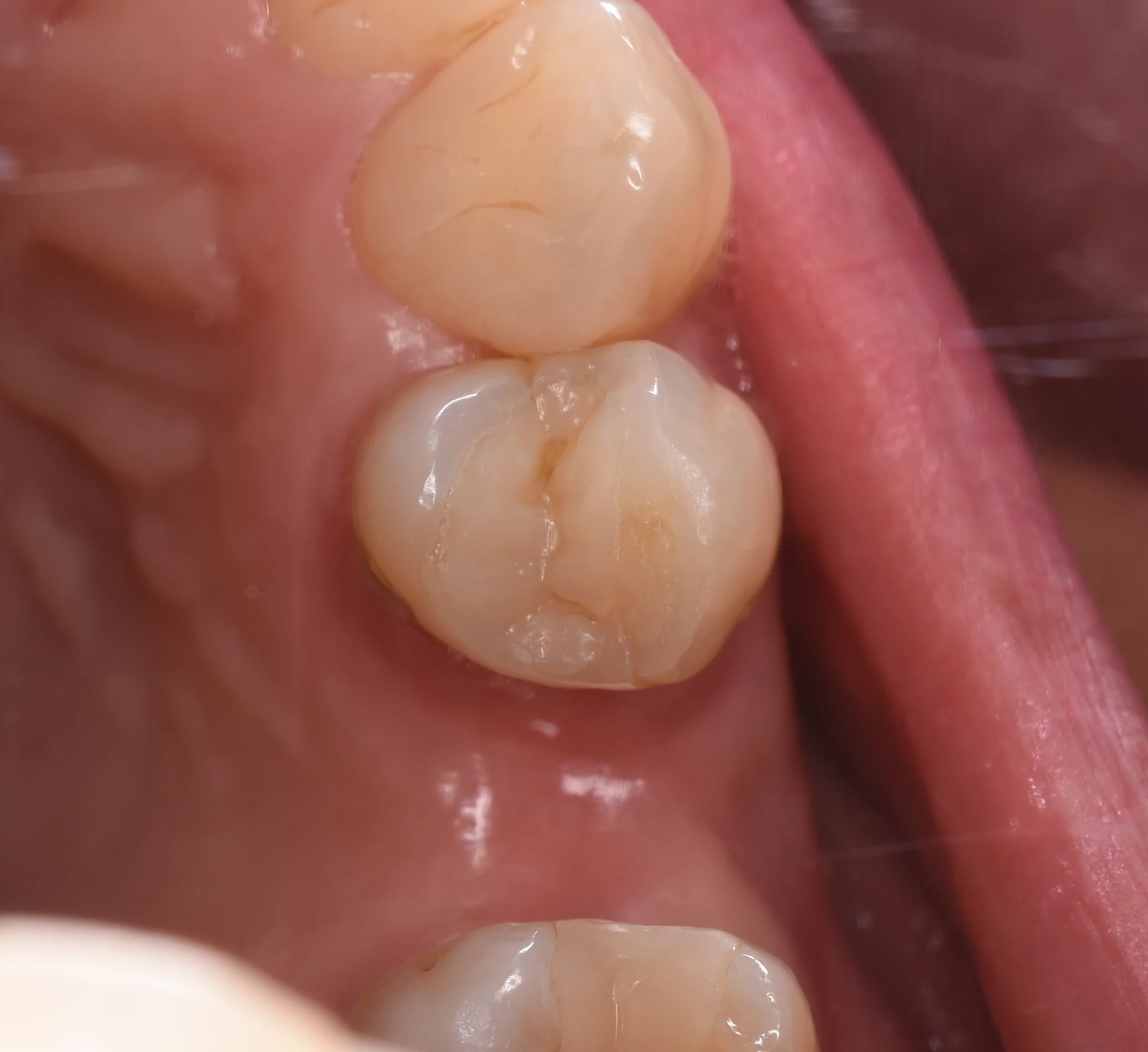 ダイレクトボンディング術後4年での補修修復|坂寄歯科医院(取手市藤代)