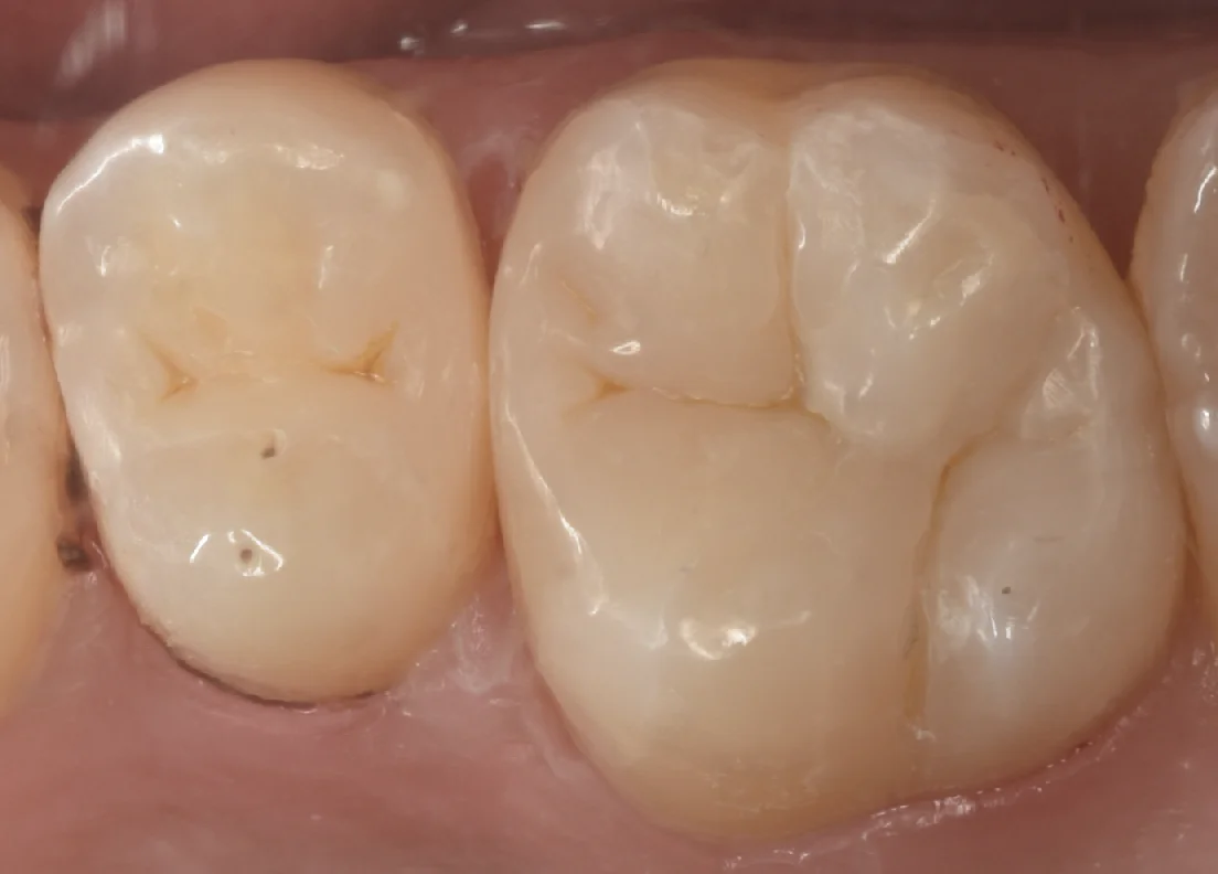 金属の詰め物を白い詰め物に。｜坂寄歯科医院（取手市藤代） - 画像3