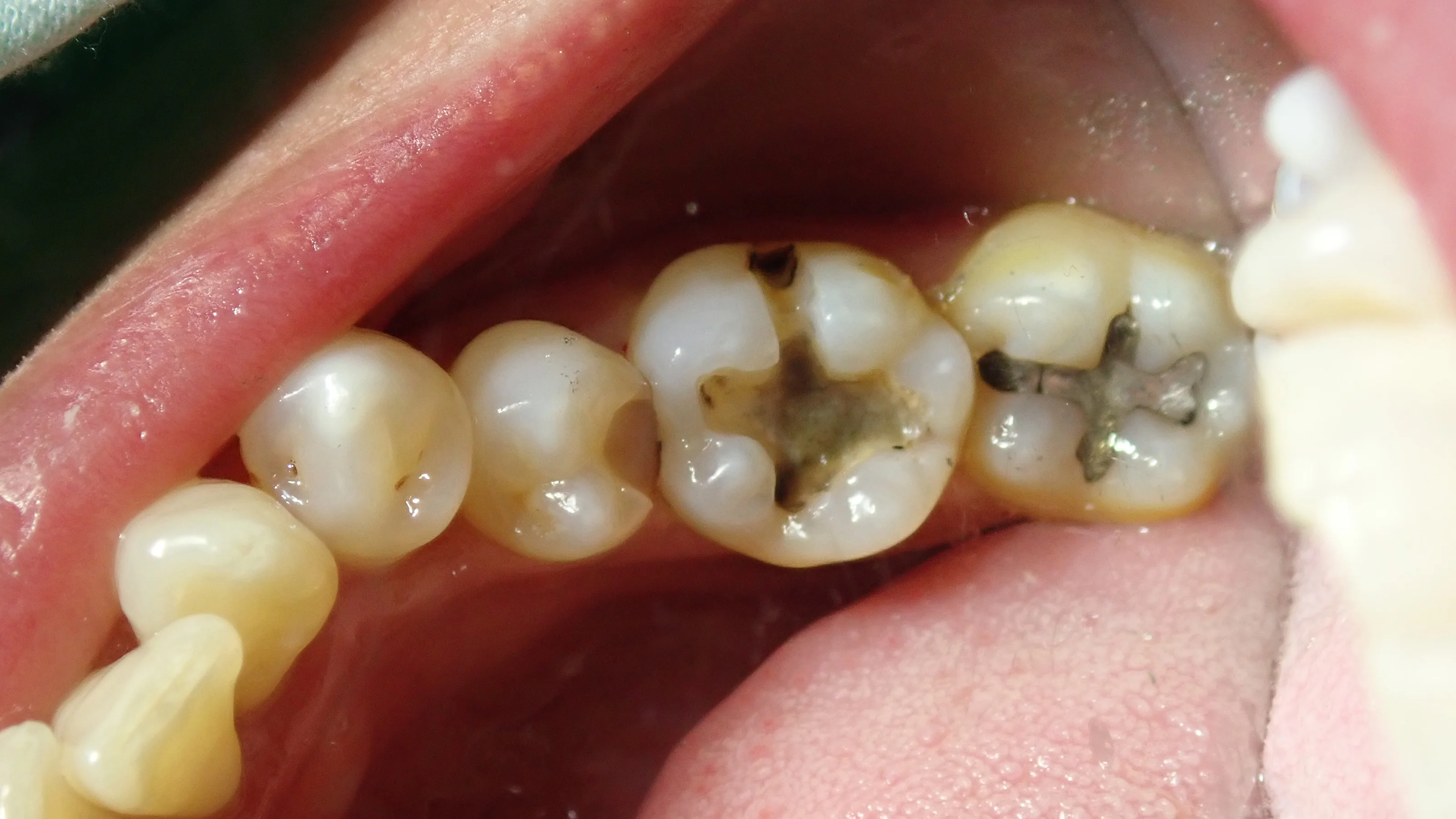 下の奥歯2本の詰め物|坂寄歯科医院(取手市藤代) - 画像2