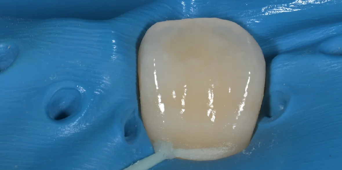 ICON治療にてホワイトスポットを改善。|坂寄歯科医院(取手市藤代) - 画像4