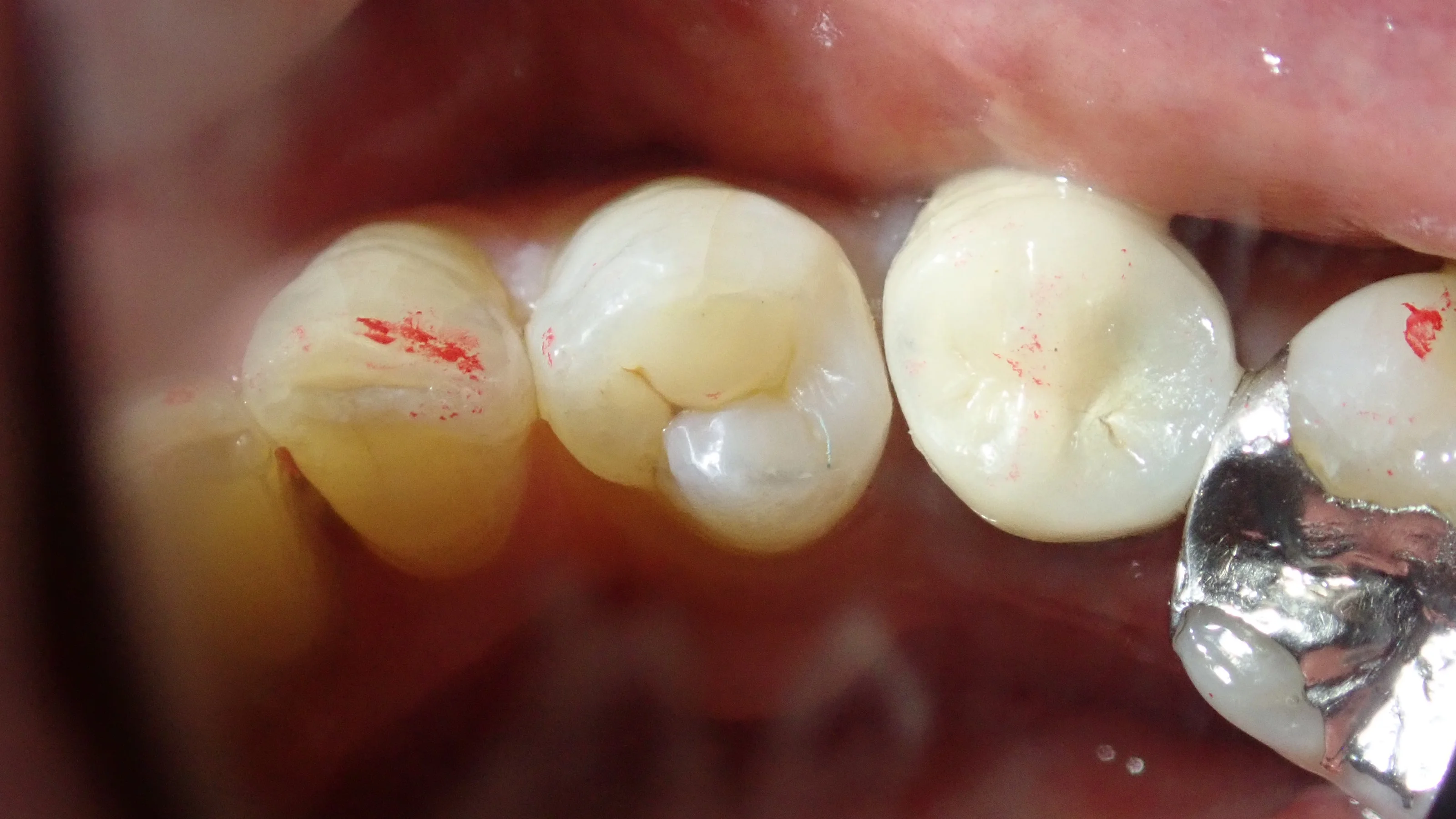 ダイレクトボンディング｜坂寄歯科医院（取手市藤代） - 画像4