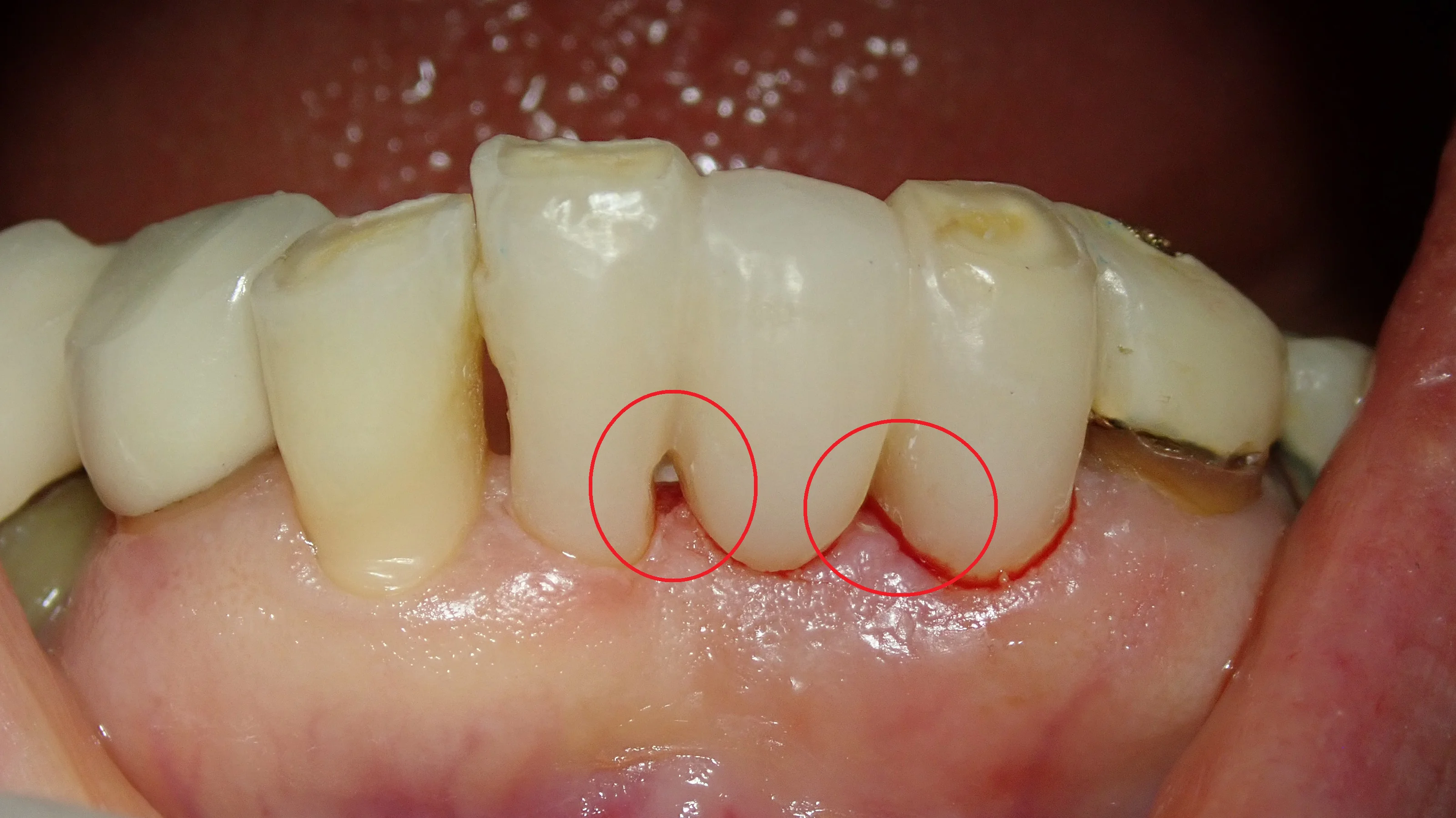接着性ブリッジ|坂寄歯科医院(取手市藤代) - 画像3