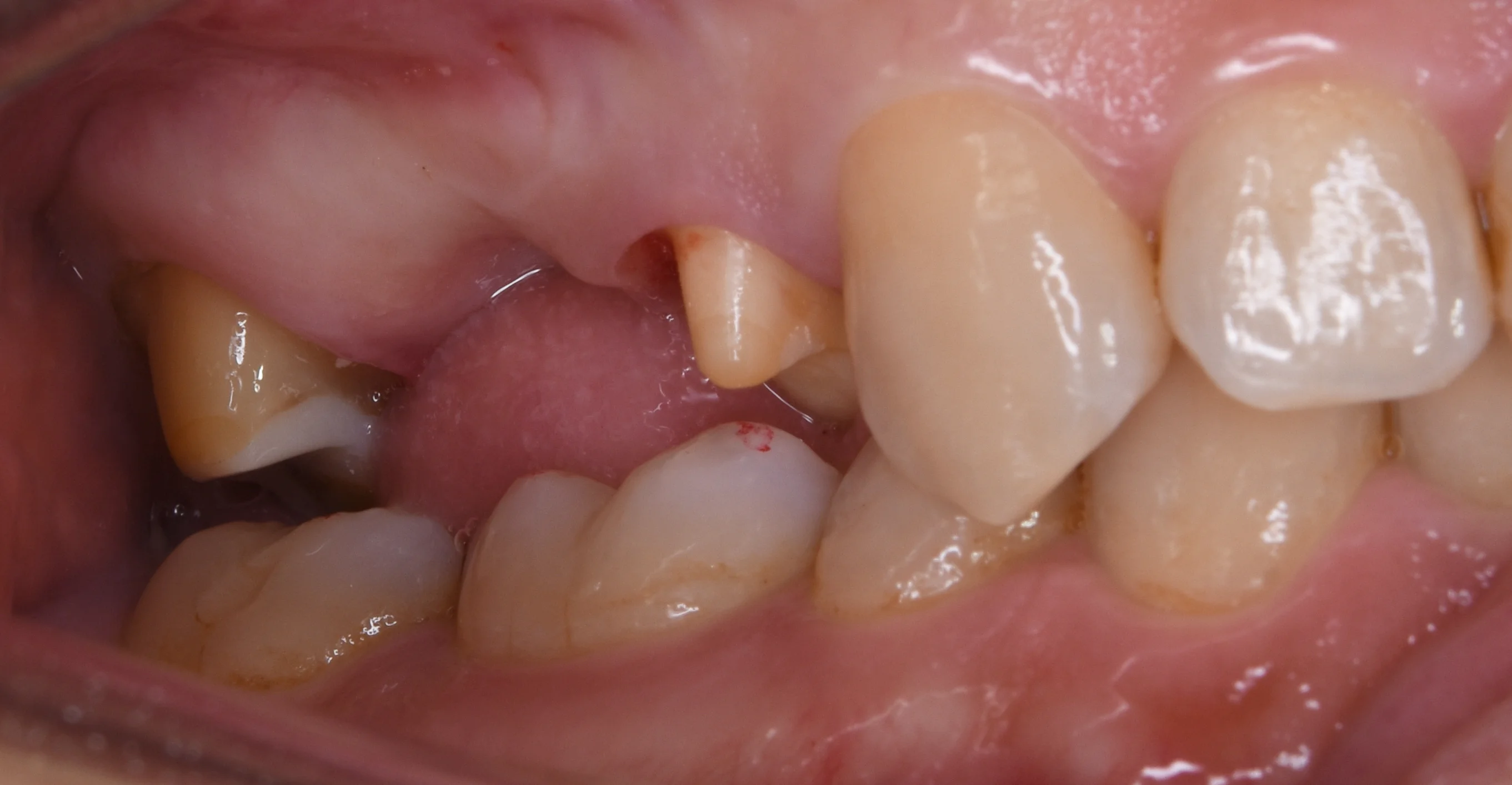 セラミックのブリッジ|坂寄歯科医院(取手市藤代)