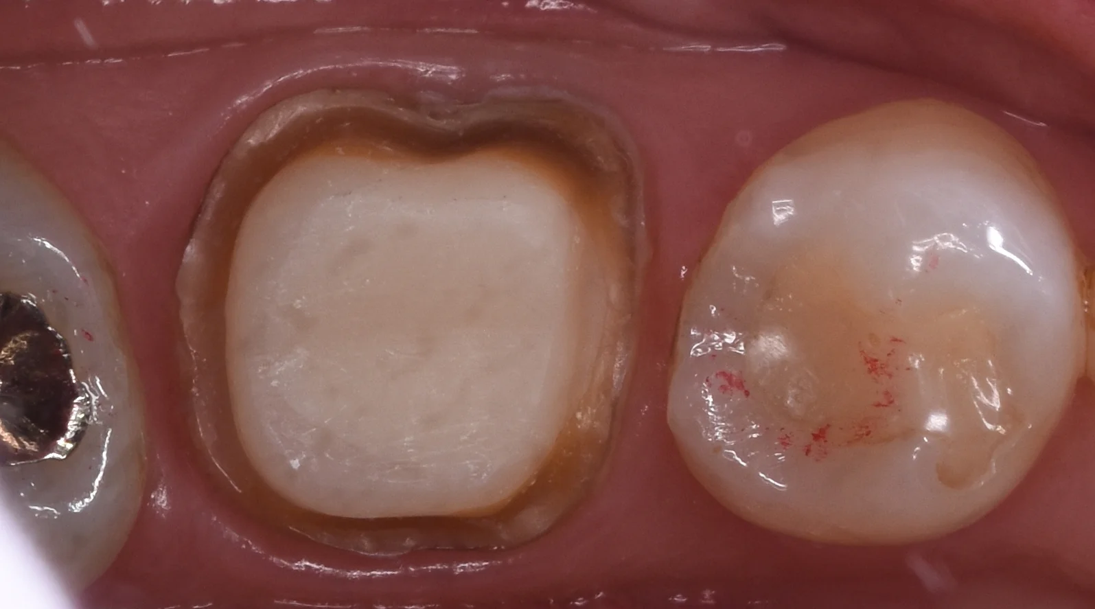 セラミックの被せ物|坂寄歯科医院(取手市藤代) - 画像2