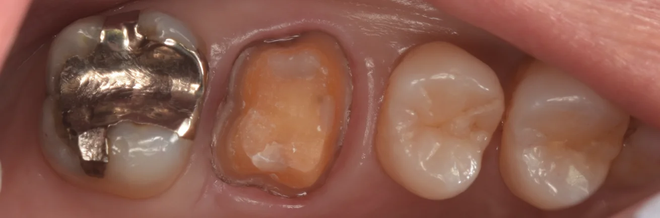 虫歯の治療後セラミックの被せ物に。｜坂寄歯科医院（取手市藤代）