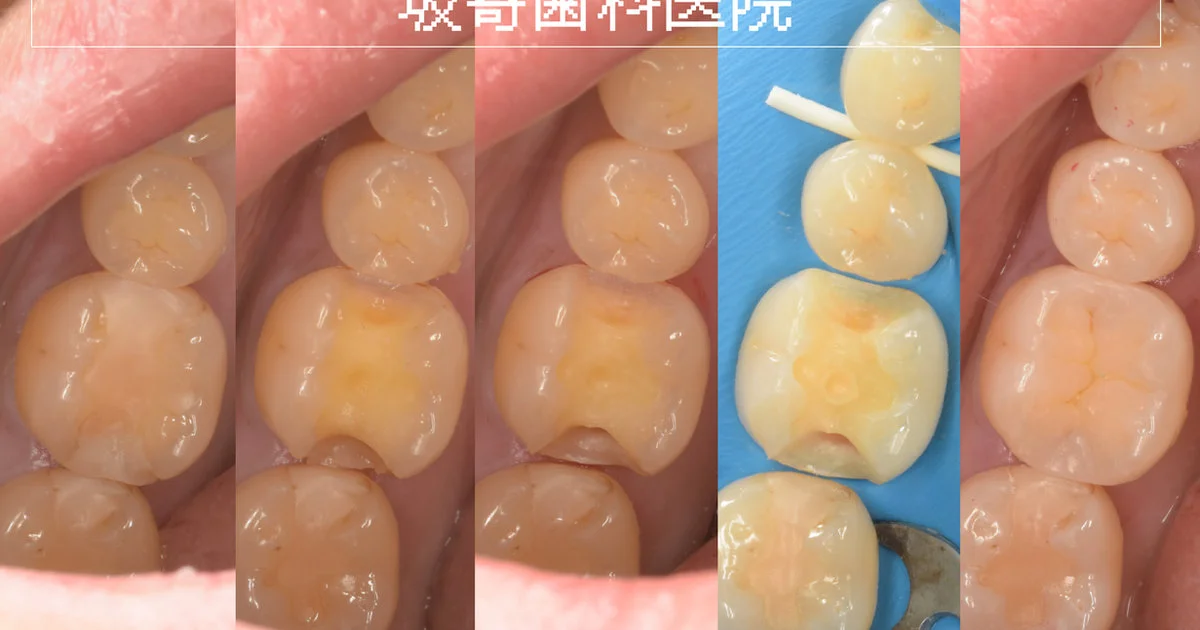 ダイレクトボンディング症例