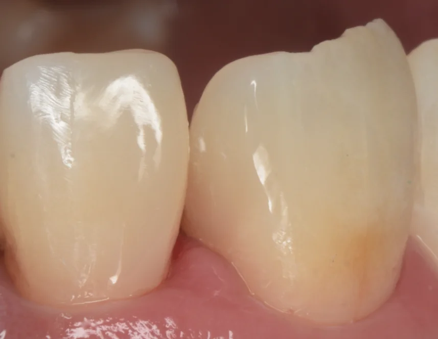 不適合なレジンを再治療。|坂寄歯科医院(取手市藤代) - 画像3