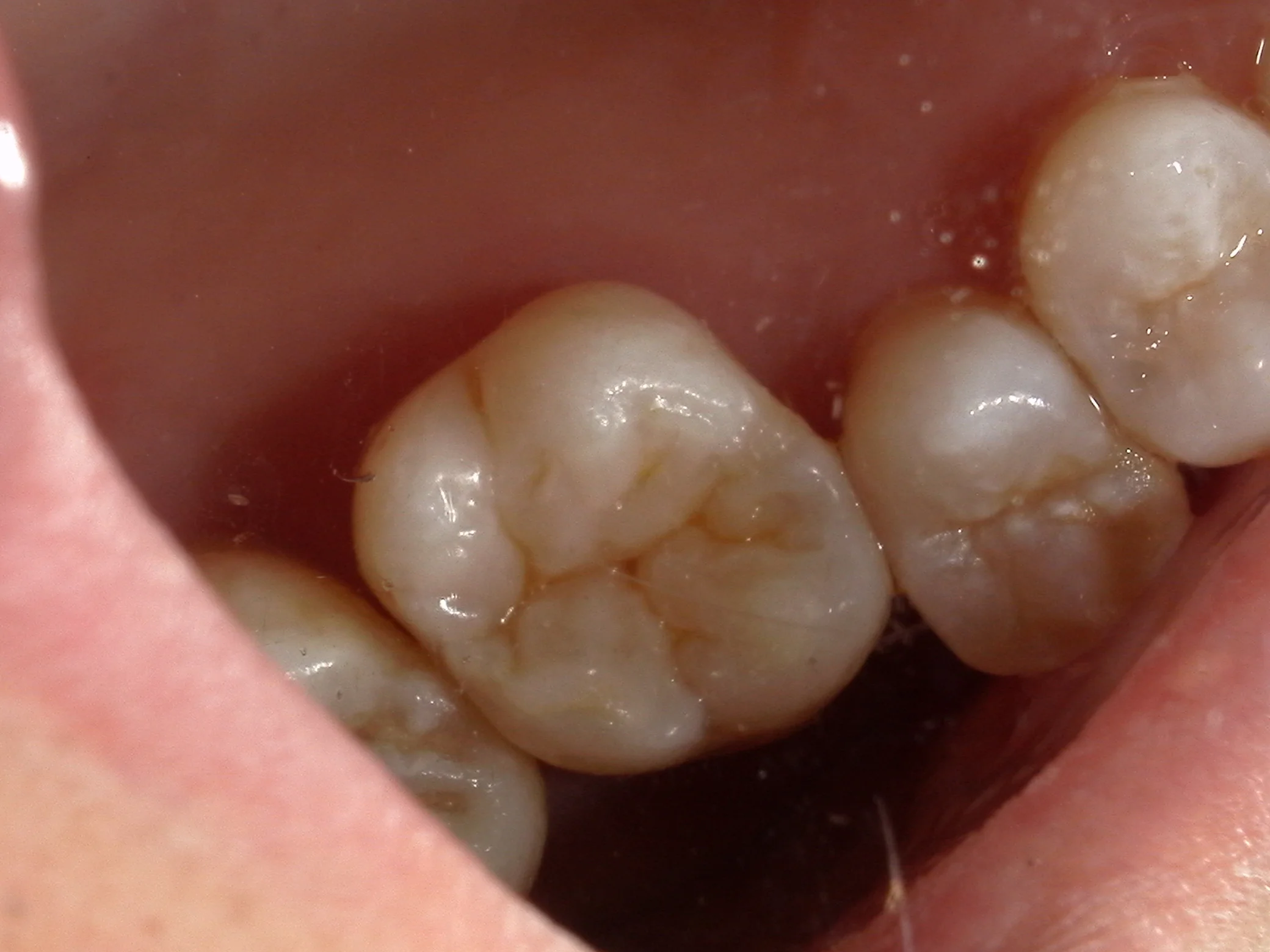 右上6ダイレクトボンディング|坂寄歯科医院(取手市藤代) - 画像5